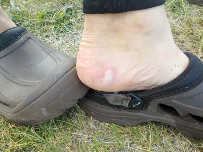 One of Mike's many blisters